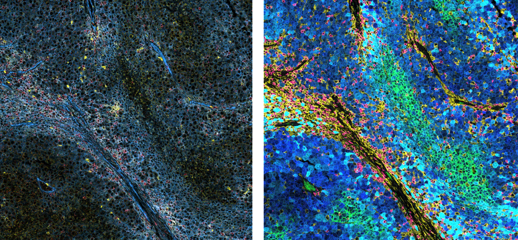 Melanoma tissue analyzed by imaging mass cytometry (<em>Left:</em> blue=MHC-I, yellow=PD-L1, red=PD1. <em>Right:</em> blue=GP100, cyan=S100A, green=Glut1, yellow=CD16, red=CD8.)