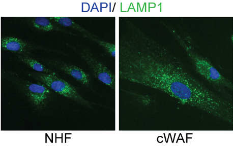 Immunofluorescence staining of lysosomes <em>(green)</em>, and counterstaining of nuclei <em>(blue)</em> in normal human fibroblasts (NHF) and chronic wound-associated fibroblasts (cWAF). cWAF exhibit an enlarged and delocalized lysosomal compartment.