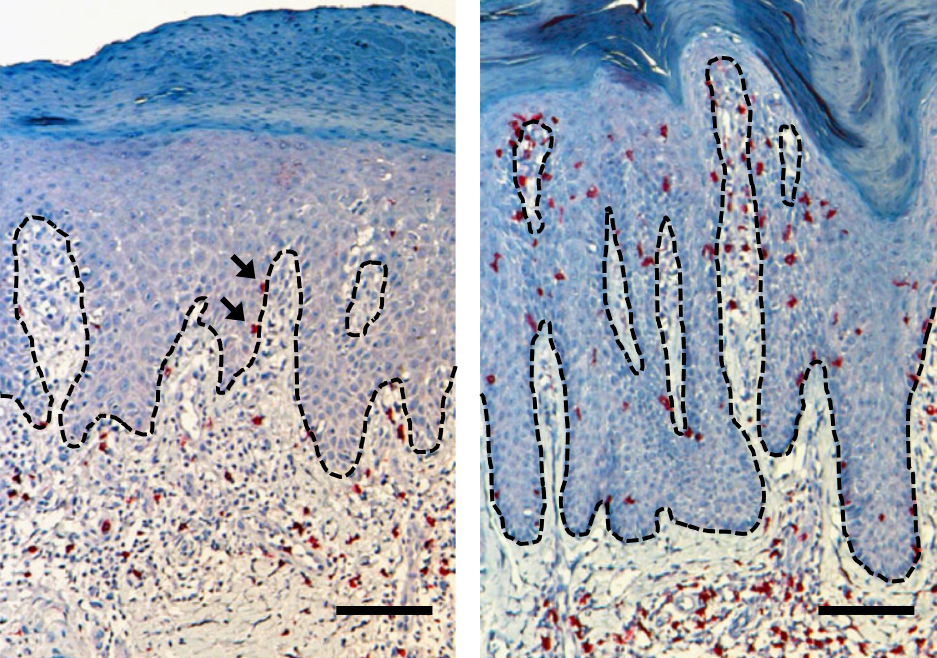 Comparison of paradoxical psoriasis <em>(left)</em> and classical psoriasis <em>(right)</em> in CD8 stainings. Dashed lines indicate the border between the dermis and epidermis. Arrows indicate intraepidermal CD8<sup>+</sup> T cells in paradoxical psoriasis. Scale bars represent 50 μm.