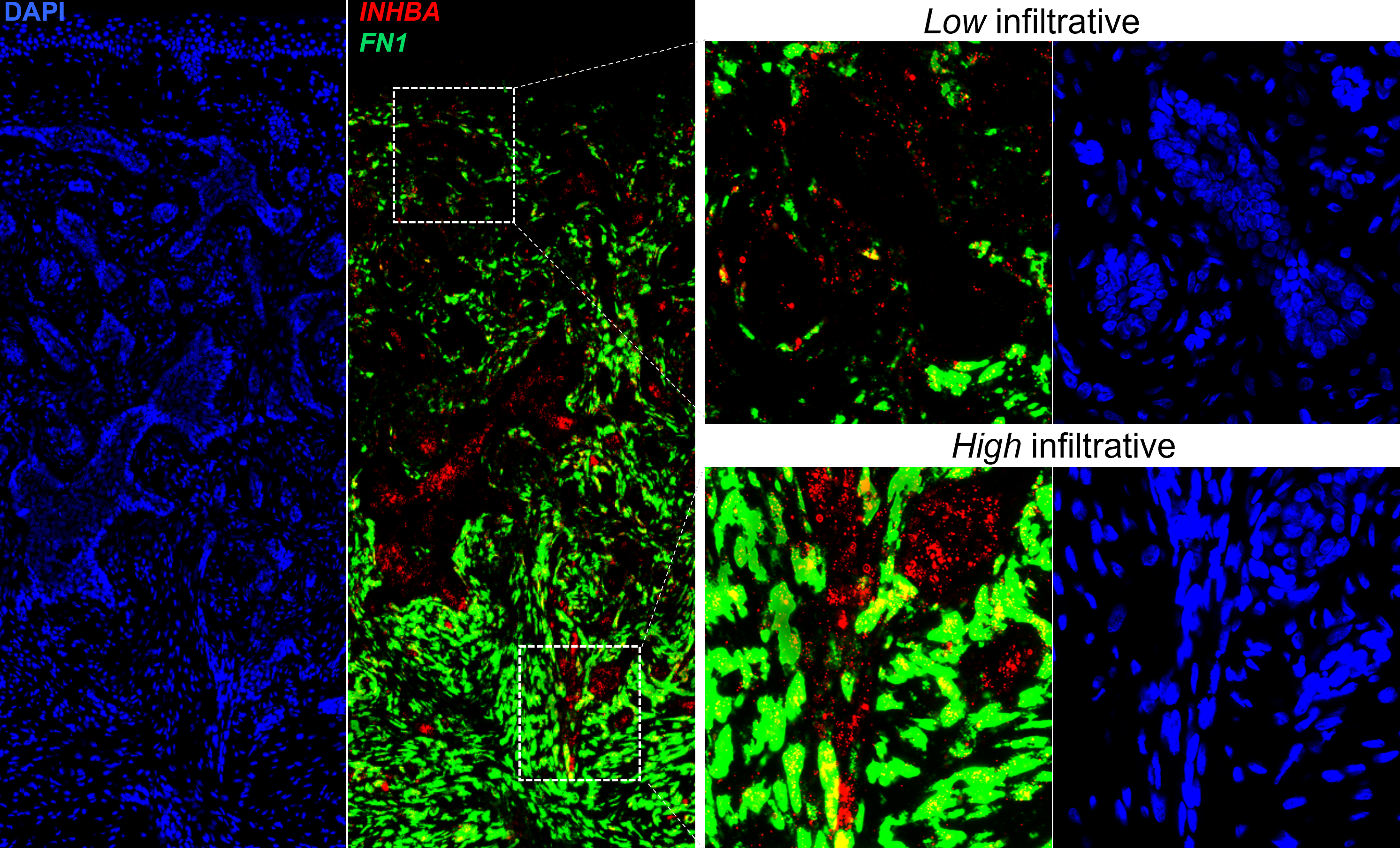RNA FISH staining for <em>INHBA</em> (red) and <em>FN1</em> (green) illustrating associated morphological progression and reprogramming in cancer cells and surrounding microenvironment in basal cell carcinoma.