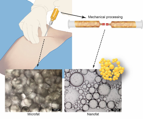 Microfat is harvested using 2.7 mm cannulas with 1 mm holes and contains viable adipocytes as well as a stromal vascular fraction. It is applied to achieve a volume effect, <em>e.g.</em> in soft tissue correction of the face. Nanofat is gained by further processing, using mechanical shuffling and filtering through a titanium mesh with a predefined pore-size, which destroys the adipocytes. Nanofat can be used if no volume effect is intended to improve skin properties.